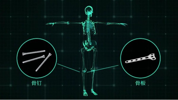 鎂夢成真 《宜安科技醫用鎂骨釘獲歐盟CE認證》